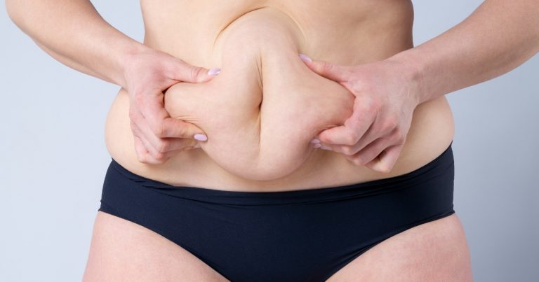 Tummy Tuck Swelling:  What to Expect and How to Manage