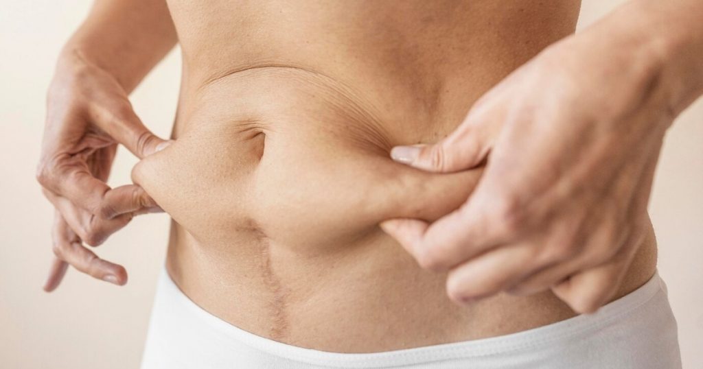 What Are The Different Types Of Tummy Tuck Incisions