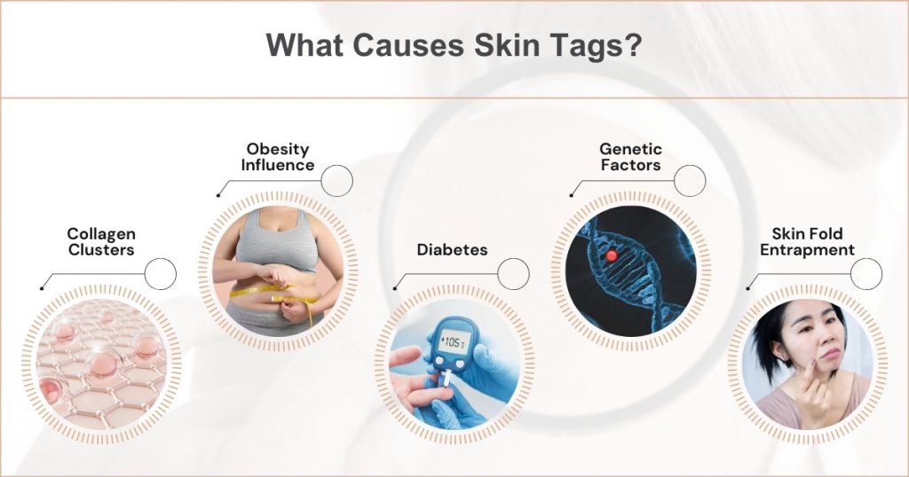What Causes Skin Tags and How to Remove Them