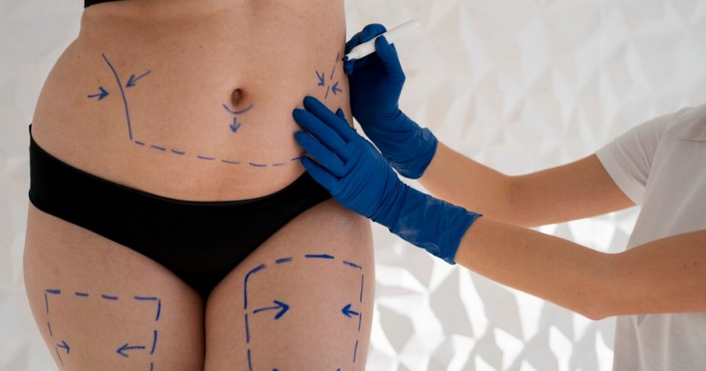 What Kinds of Body Contouring Procedures Address Loose Skin