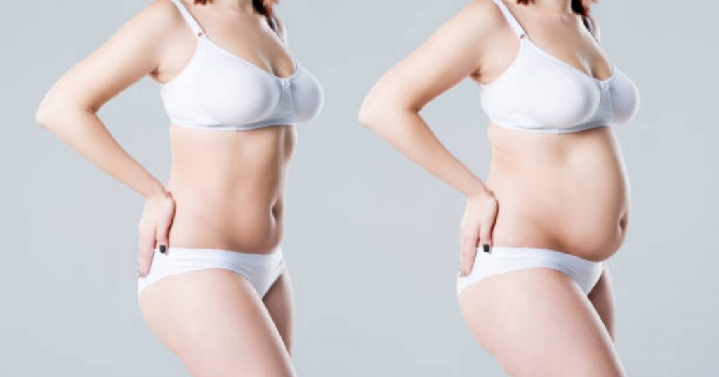 What Results Can I Expect From a Tummy Tuck