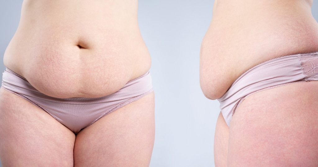 Which tummy tuck incision fades and heels are best