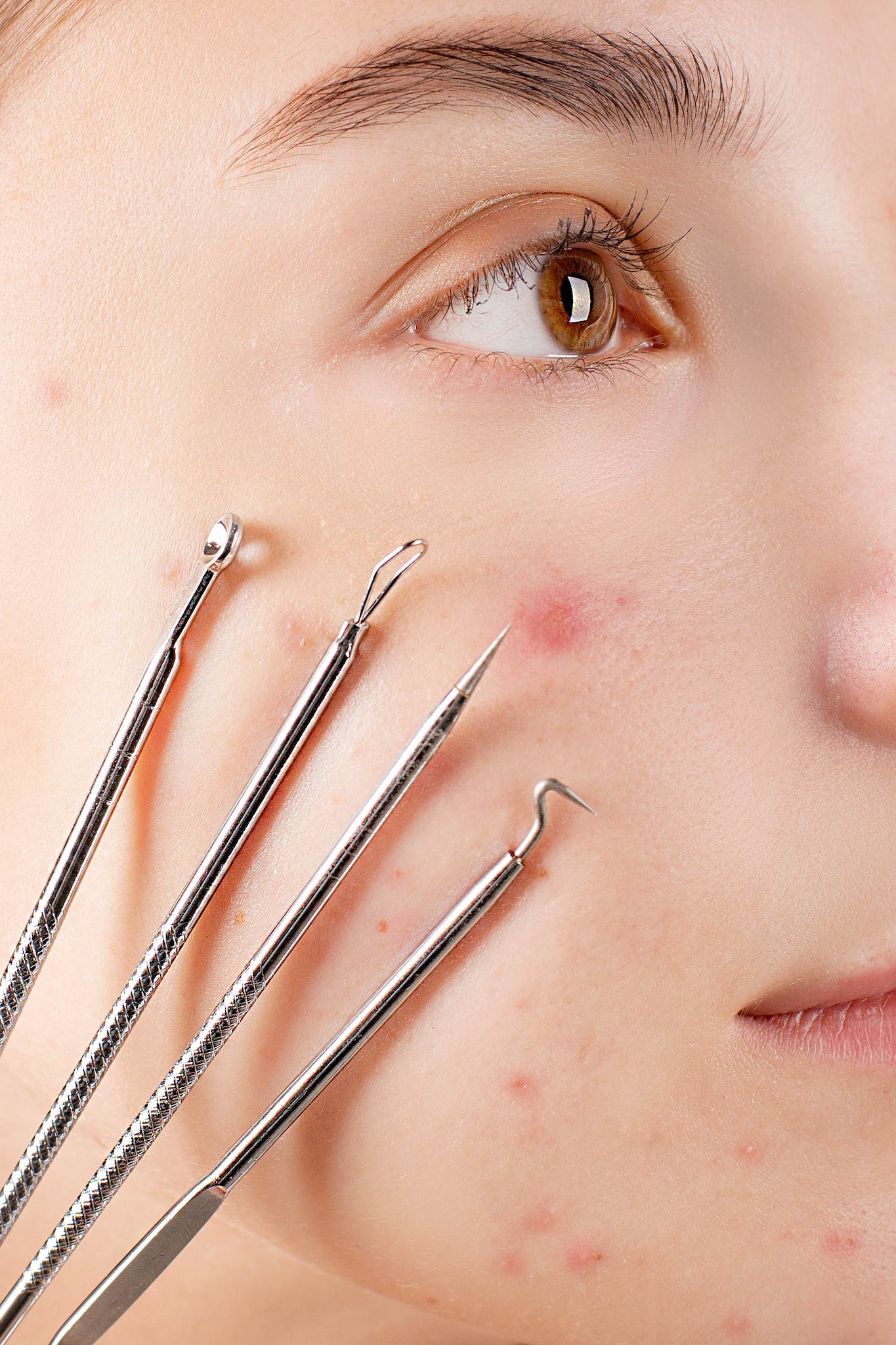 Can Skin Tags Be Removed Naturally