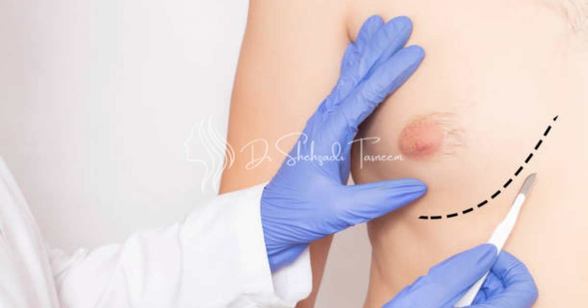 Gynecomastia Price in Dubai