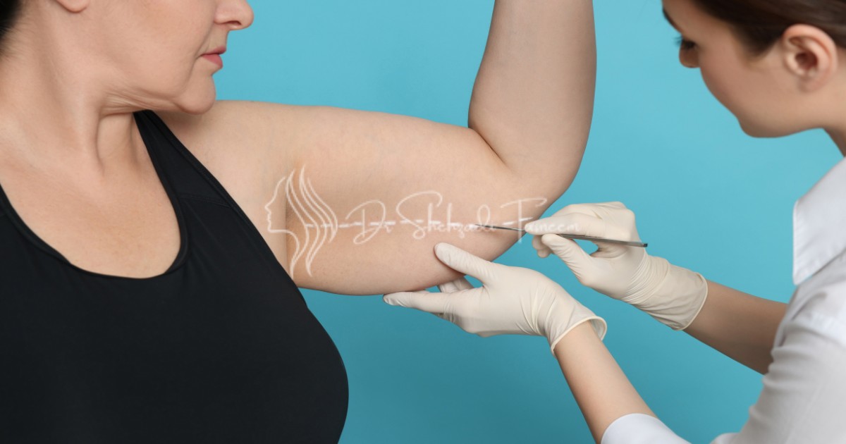 Is Arm Liposuction Worth It Exploring the Benefits