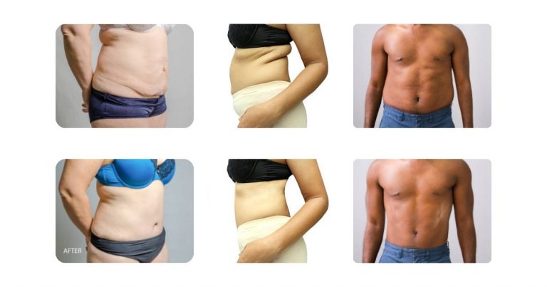 Tummy Tuck And Liposuction Before And After