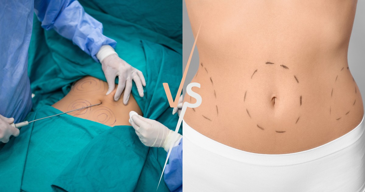 Which is More Painful Liposuction or Tummy Tuck