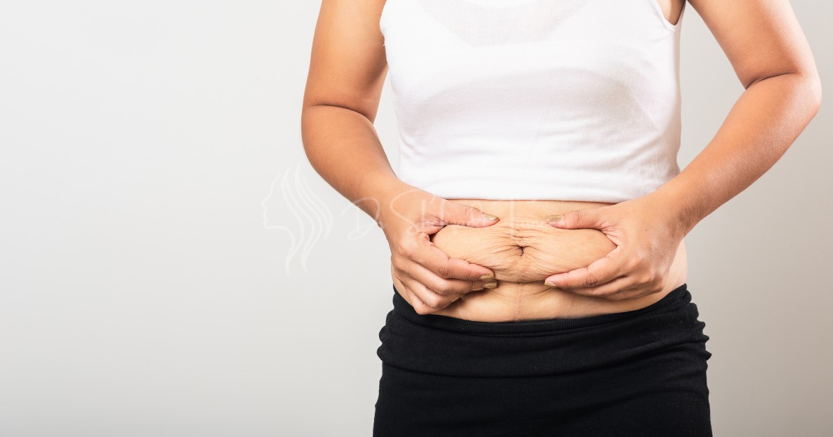 Can Tummy Tuck Cause Hernia