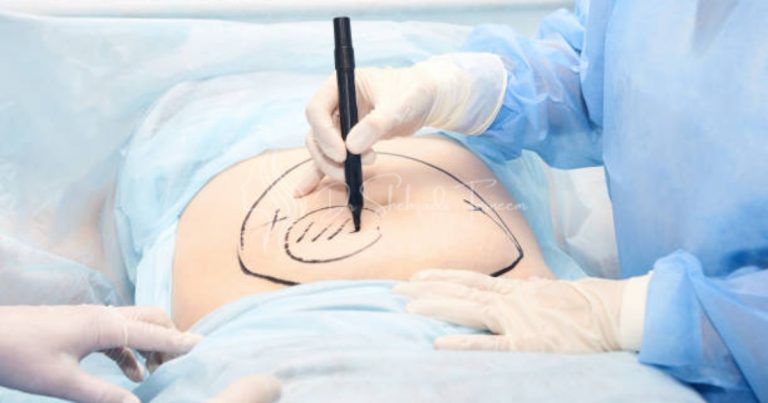 Liposuction With Tummy Tuck Cost