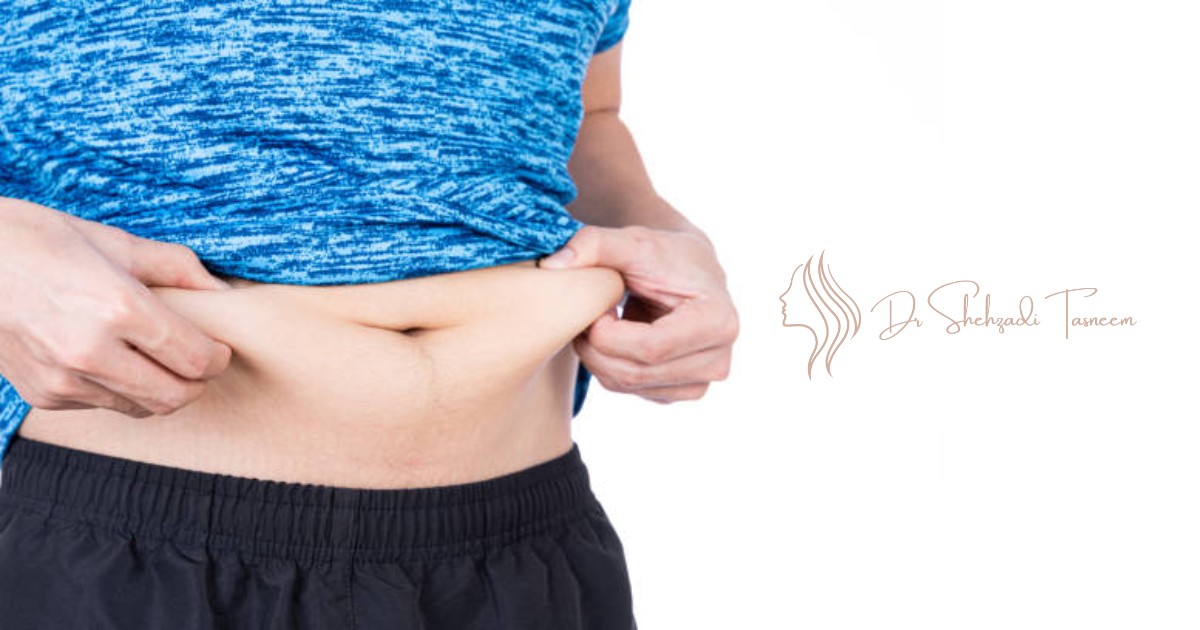 What Is A Tummy Tuck With Muscle Repair