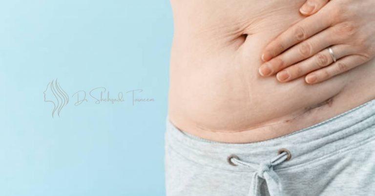 When Does Tummy Tuck Swelling Go Down
