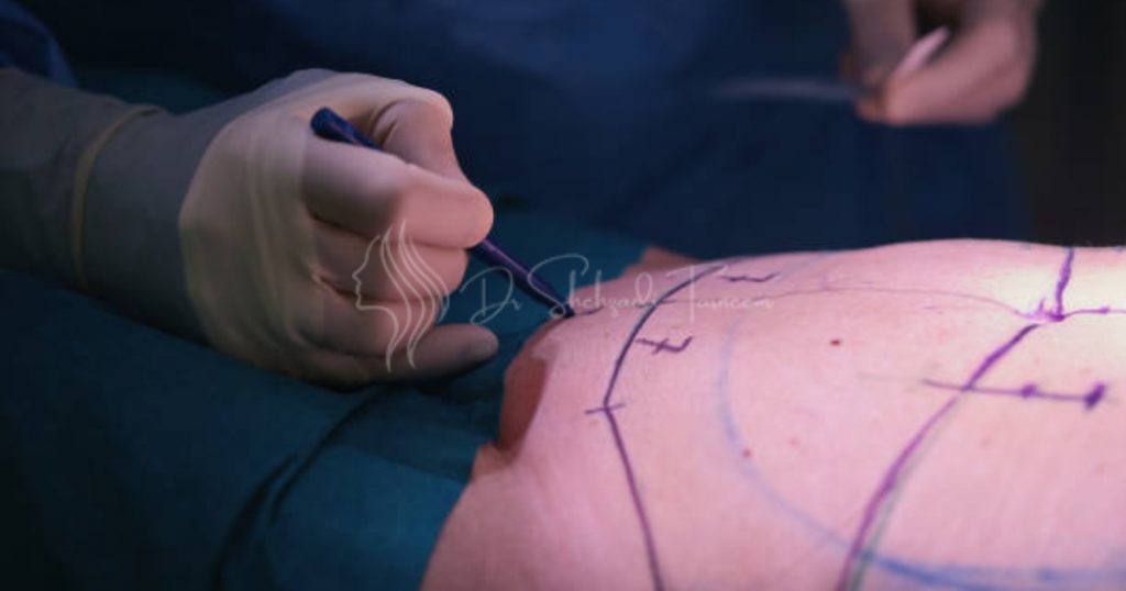 How Is A Tummy Tuck Procedure Performed? | Best Female Plastic Surgeon ...