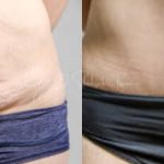 Is A Tummy Tuck Safe