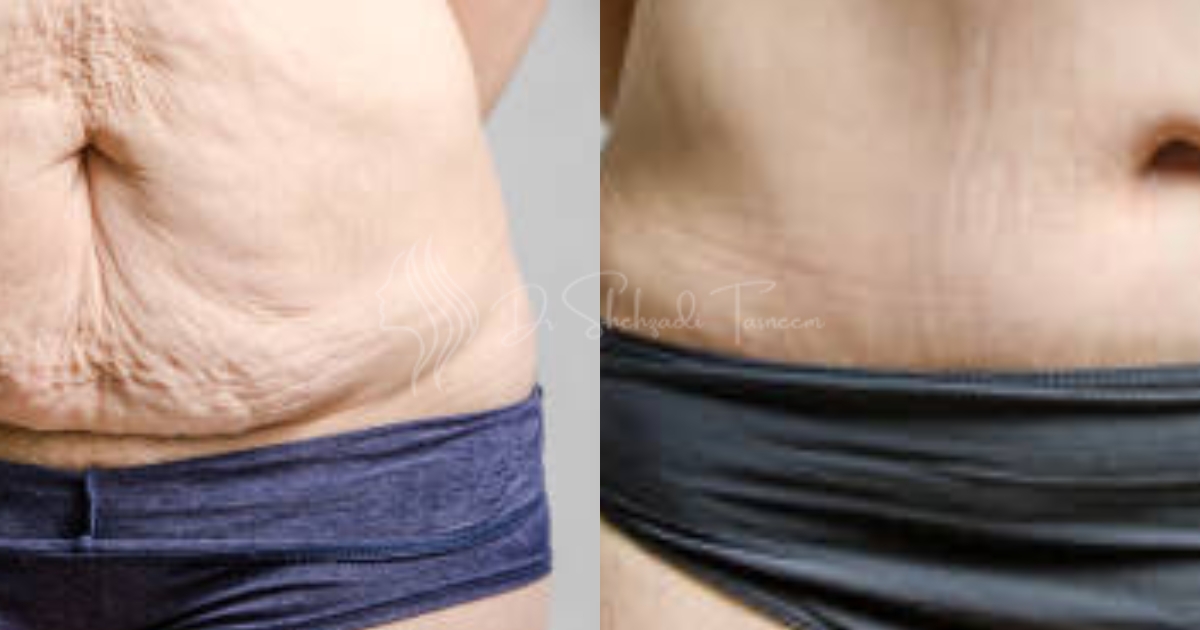 Is A Tummy Tuck Safe