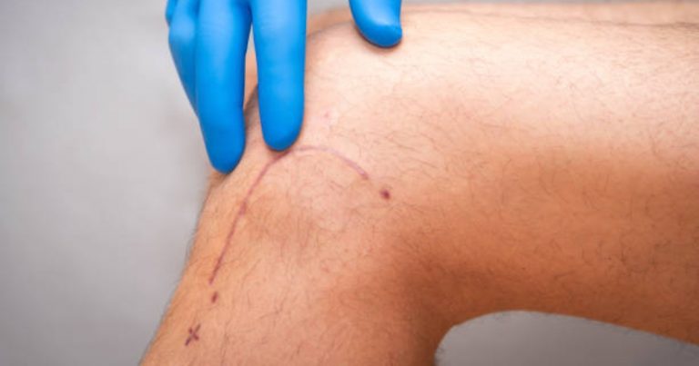 What Causes Keloid Scars After Surgery