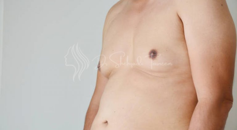 Are Drains Necessary For Gynecomastia Surgery