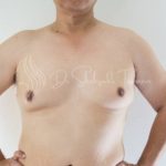 Are Gynecomastia Lumps Hard | 2024