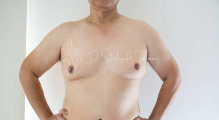 Are Gynecomastia Lumps Hard