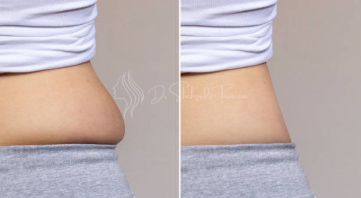 Belly Lipo Before And After | 2024