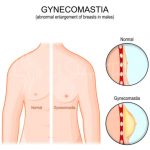 Are Gynecomastia Surgery Effective for Male Breast Reduction | 2024