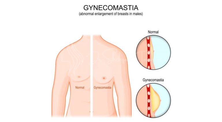 Are Gynecomastia Surgery Effective for Male Breast Reduction