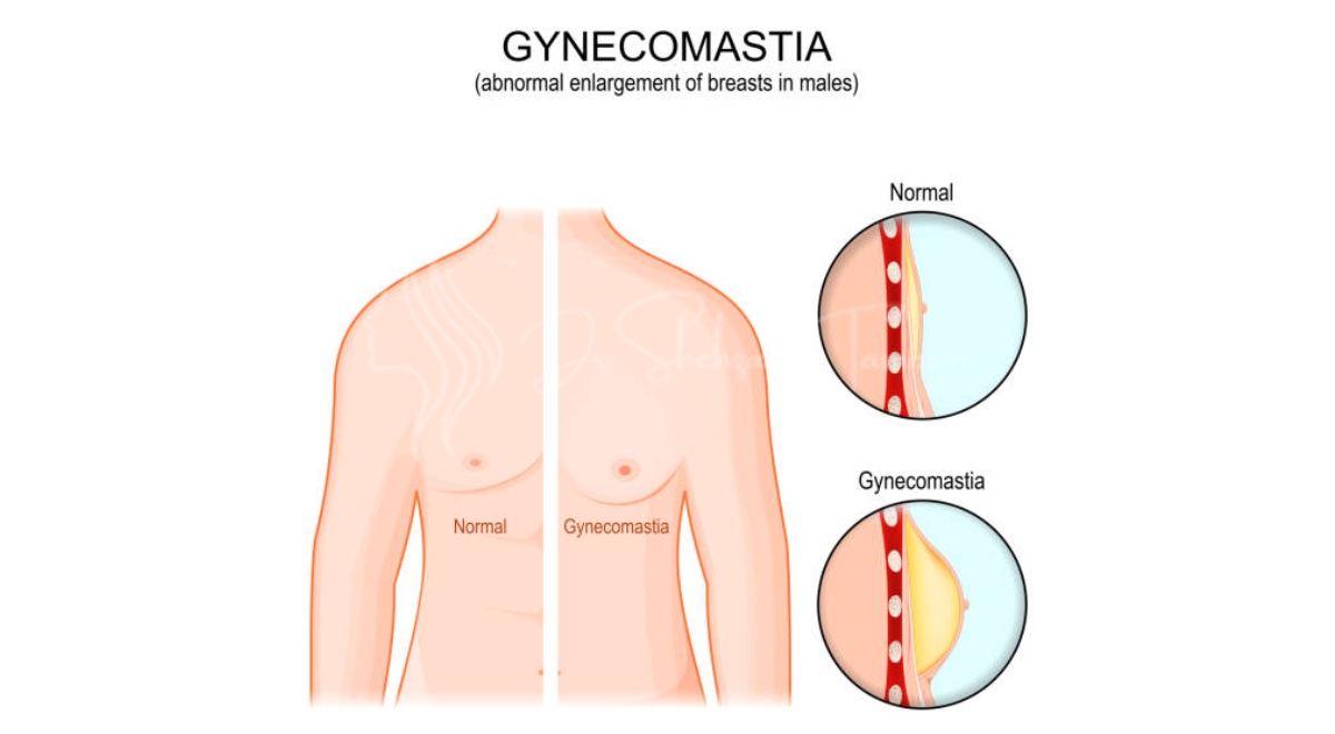 Are Gynecomastia Surgery Effective for Male Breast Reduction | 2024