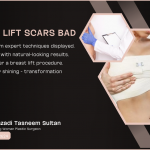 Are Breast Lift Scars Bad | 2024