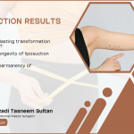 Are Liposuction Results Permanent | 2024