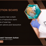 Are Liposuction Scars Noticeable | 2024