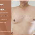 Are You Born With Gynecomastia | 2024